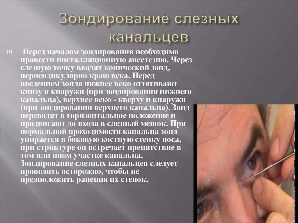 Что значит зондирование. Зондирование слезных канальцев. зондирование и промывание слезных путей. зондирование носослезного канала. промывание слезного мешка.