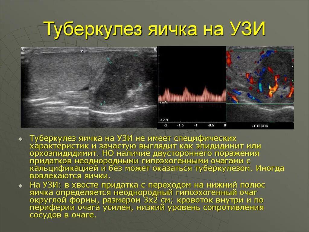 Туберкулез придатка яичка. Генитальный туберкулез УЗИ. Туберкулез мужских половых органов.