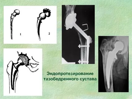 Эндопротезирование тазобедренного сустава в ростове