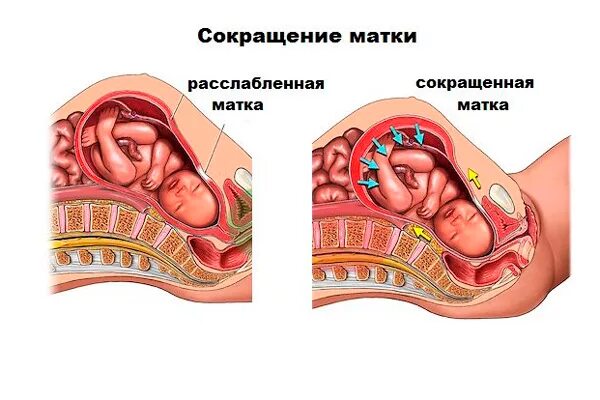 Гипертонус Матки Можно Заниматься Сексом