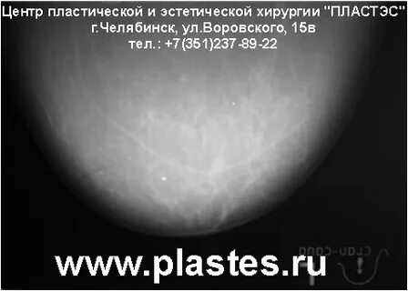 Неполная жировая инволюция