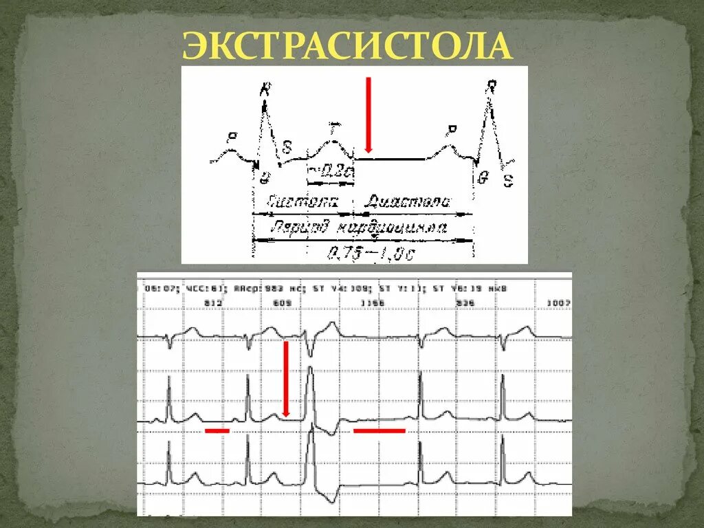 Экстрасистолы днем