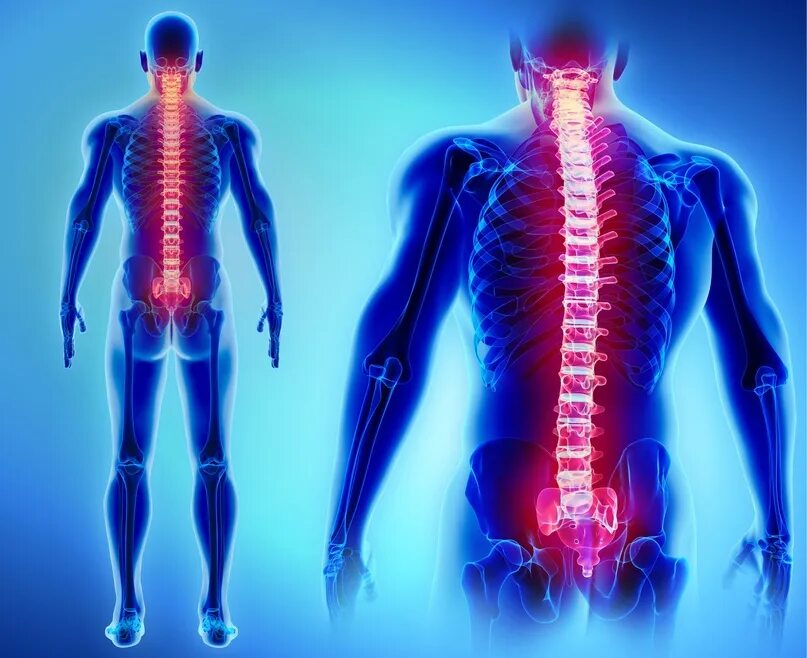 Kyphosis lordosis flat Royalty Free Vector Image