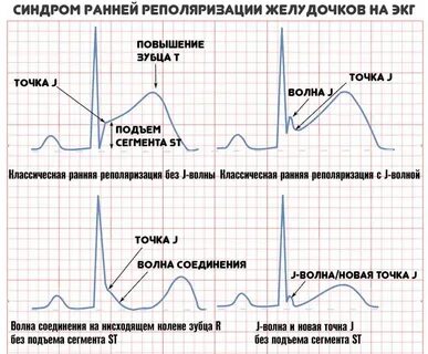 Нарушение процессов реполяризации в миокарде у ребенка