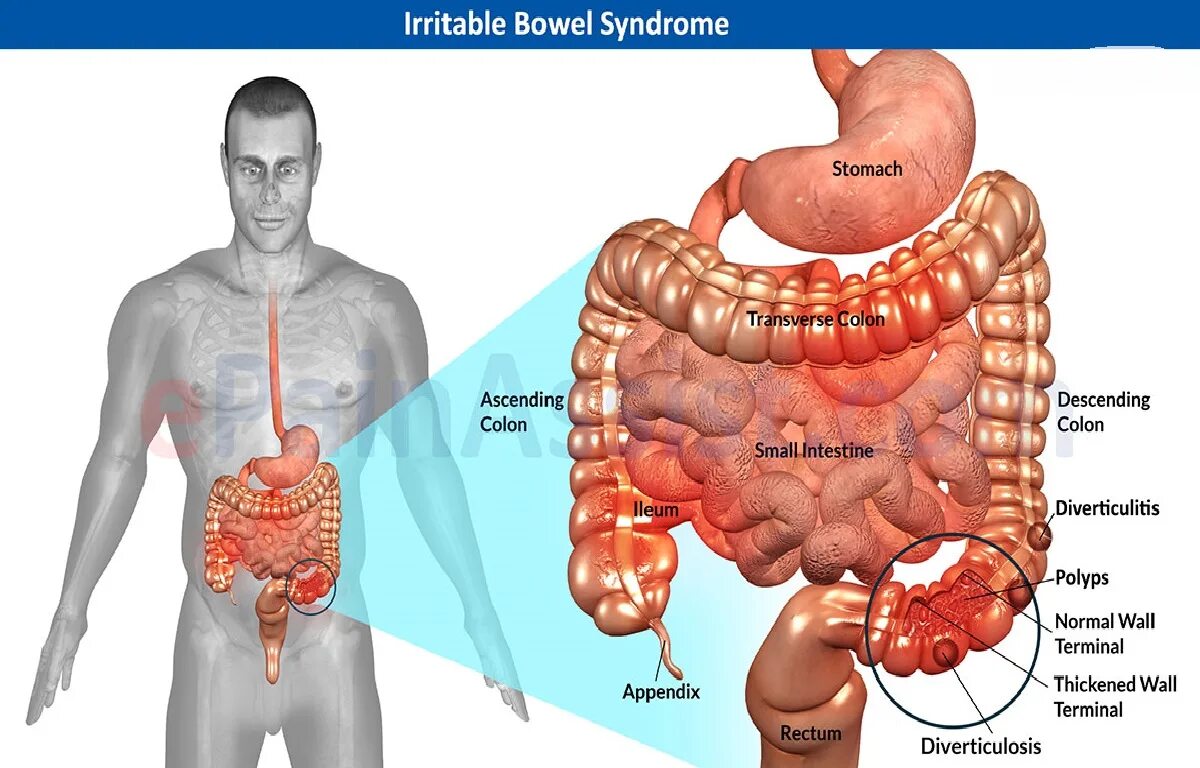 Раздраженный кишечник симптомы и лечение у мужчин. Синдром раздраженного кишечника. Раздраженный кишечник. Синдром раздраженной кишки. Синдром раздражённо го кишечника.
