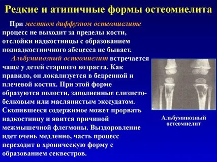 Воспаление перелома