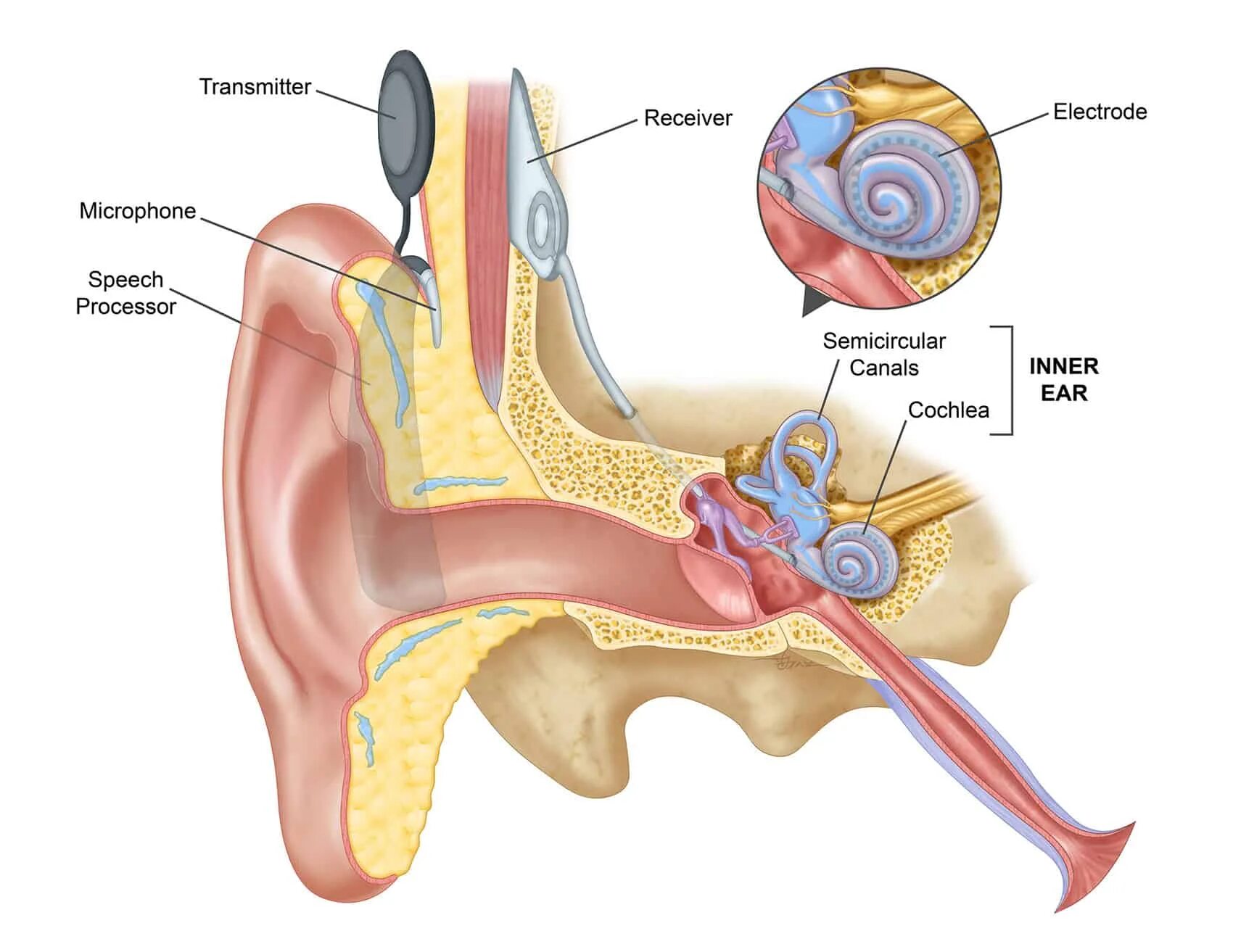 Кохлеарный аппарат. Кохлеарный имплант кохлеар. Кохлеарная часть внутреннего уха. Hear system