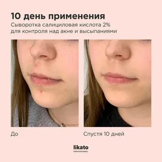 Сыворотки для лица с салициловой кислотой