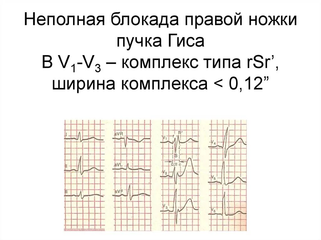 Блокада правой ножки желудочка. Неполная блокада ножек пучка Гиса. Неполная блокада ножек пучка Гиса на ЭКГ. Блокада ножек пучка Гиса на ЭКГ полная и неполная. Признаки неполной блокады правой ножки пучка Гиса на ЭКГ.