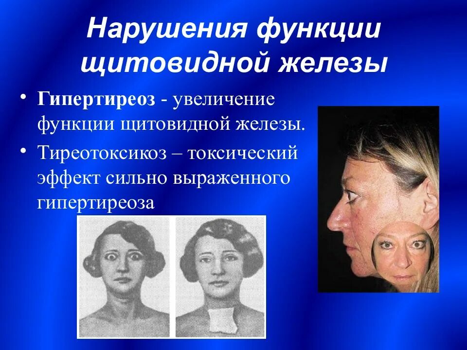Гиперфункции желез. Нарушение функции щитовидной железы ( гиперфункция). тиреотоксикоз гиперфункция щитовидной железы. заболевания при нарушении функций щитовидной железы. гиперфункция гормонов щитовидной железы.