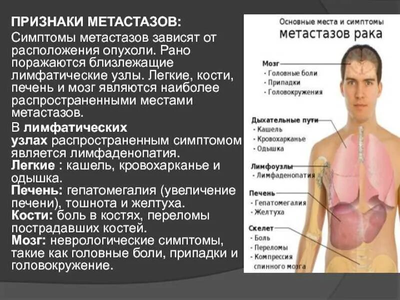Метастазы прогноз срока. Метастазы прогноз срока