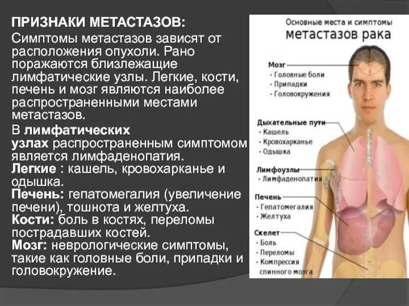 Признаки метастаз при раке. Метастазы в лимфатические узлы.