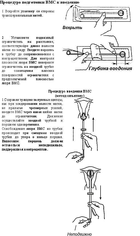 Введение вмс. Спираль внутриматочная схема установки. Инструкция по установке ВМС. Техника введения спирали Мирена. Спираль Мирена схема установки.