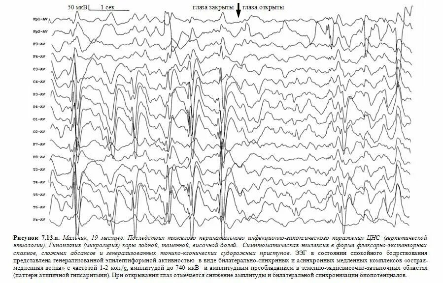 Ээг глаза. Дэрд на ЭЭГ. Эпилептиформная активность на ЭЭГ. Эпилептический статус ЭЭГ. ЭЭГ паттерн Дэрд.