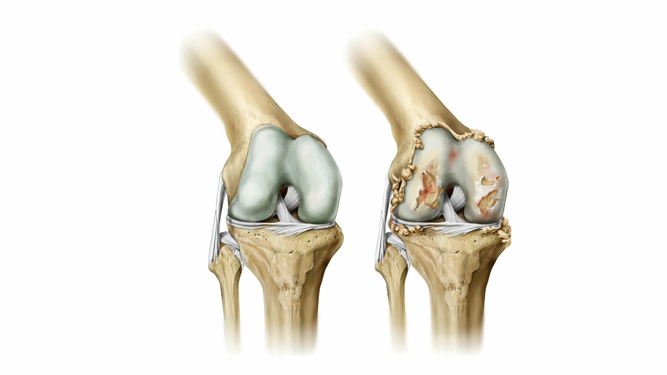 1 пр клонить колени. Остеоартрит коленного сустава. Гонартроз 1-2 степени коленного сустава. Деформирующий остеопороз коленного сустава. Деформирующий гонартроз коленного сустава.