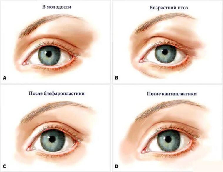 Кантопластика и кантопексия. Медиальная кантопластика внутреннего угла глаза. Кантопексия/кантопластика нижних век. Кантопластика внешнего уголка глаза.