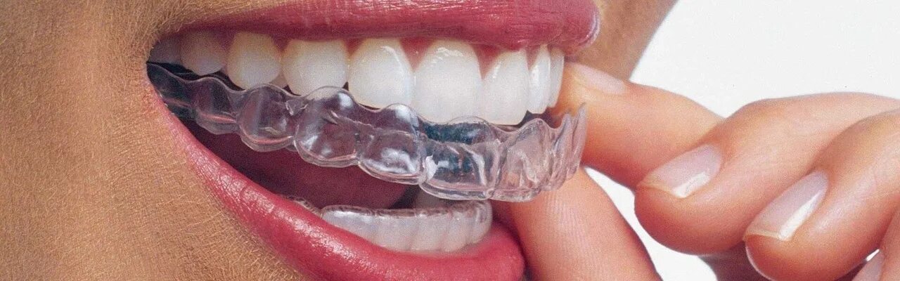 Элайнеры invisalign. Аттачменты инвизилайн. Каппа ретенционная ортодонтическая. Элайнеры ортодонтия. Пластмассовые брекеты.