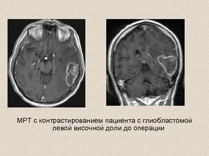 Глиобластома мрт