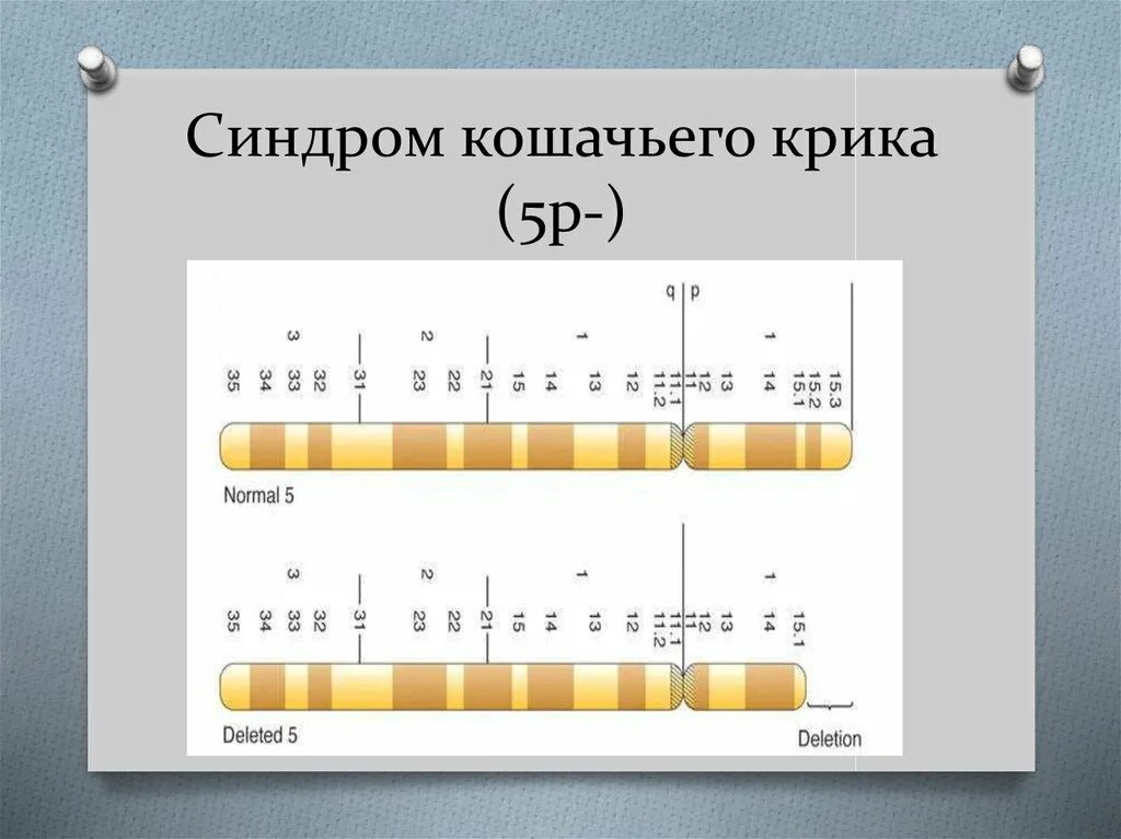 Причины кошачьего крика. Синдром кошачьего крика (делеция в 5-ой хромосоме);. синдром кошачьего крика генотип. синдром кошачбегокрика.