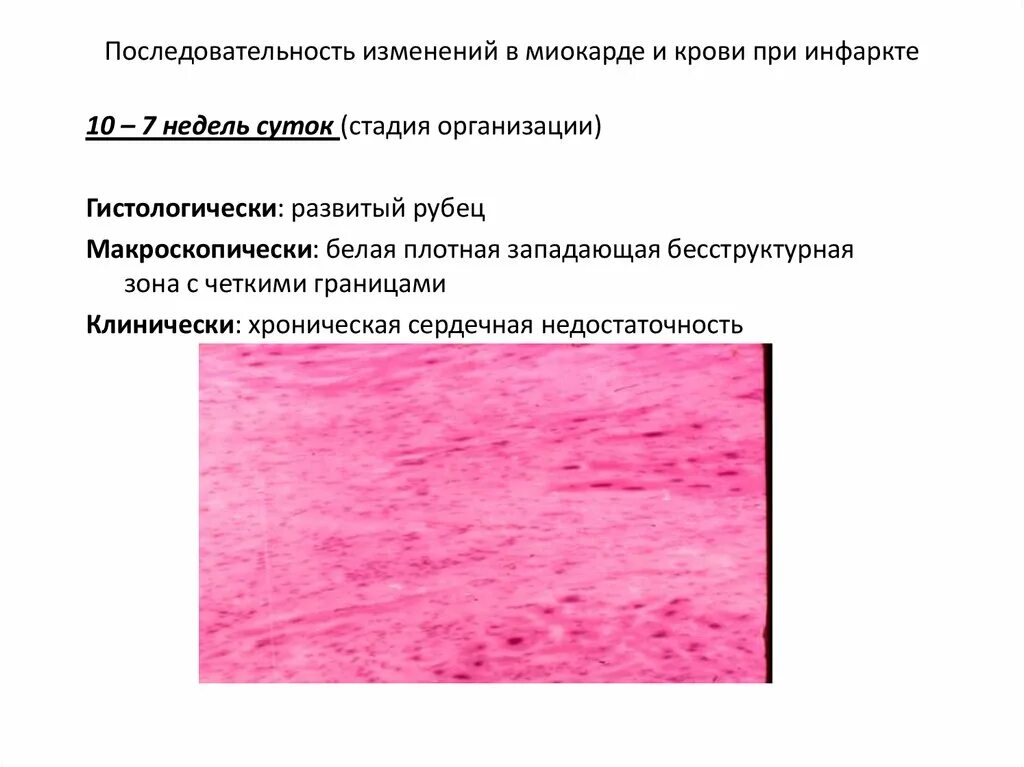 Микро изменение. Инфаркт миокарда в стадии организации микропрепарат. Инфаркт миокарда в стадии организации. Инфаркт миокарда стадия организации макропрепарат. Инфаркт миокарда в стадии организации описание.