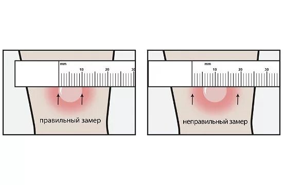 Как должна манта у ребенка. Проба манту папула 10 мм. Реакция манту у ребенка 3 года норма. Нормальная реакция манту у ребенка 1. Реакция манту норма у детей 10 лет.