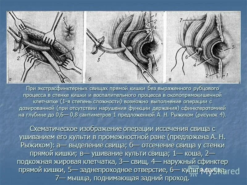 Операция дефекация. Парапроктит свищ операция. Транссфинктерные свищи прямой кишки. Иссечение 1 наружного тромбированного узла. Выбухание слизистой прямой кишки.