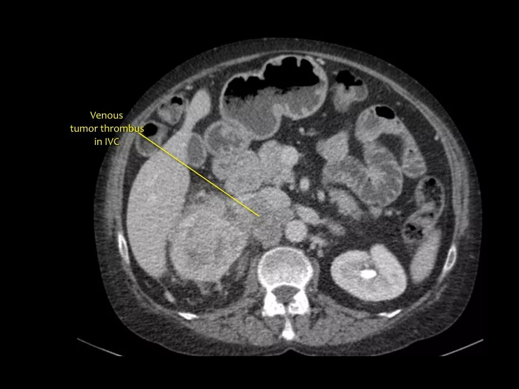 Ангиомиолипома почки мрт. Кистозно-Солидное образование. Тромбоз почечной вены кт. Тромбоз почечной вены