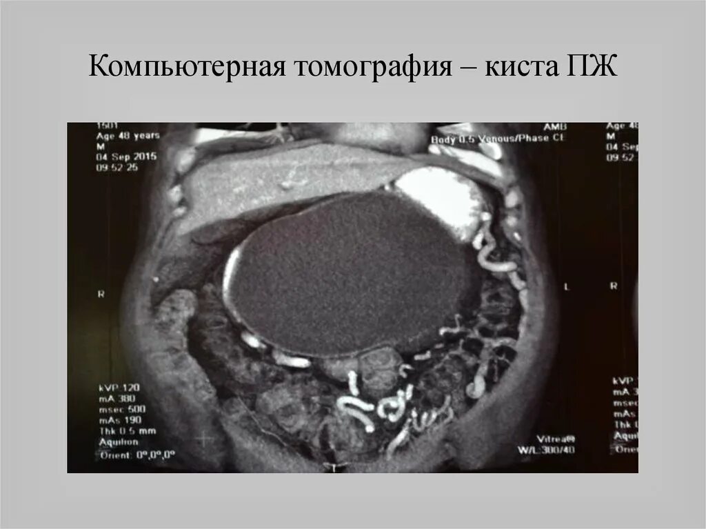 Кисты предстательной железы мрт. Киста предстательной железы на кт. Киста Мюллерова протока. Киста маточки предстательной железы на мрт.