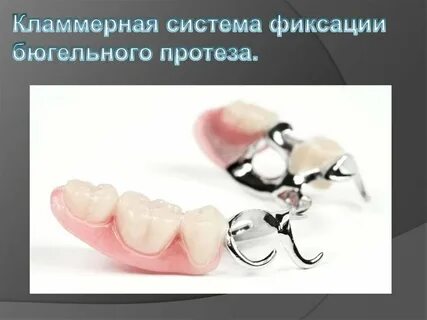 Система фиксации протезов