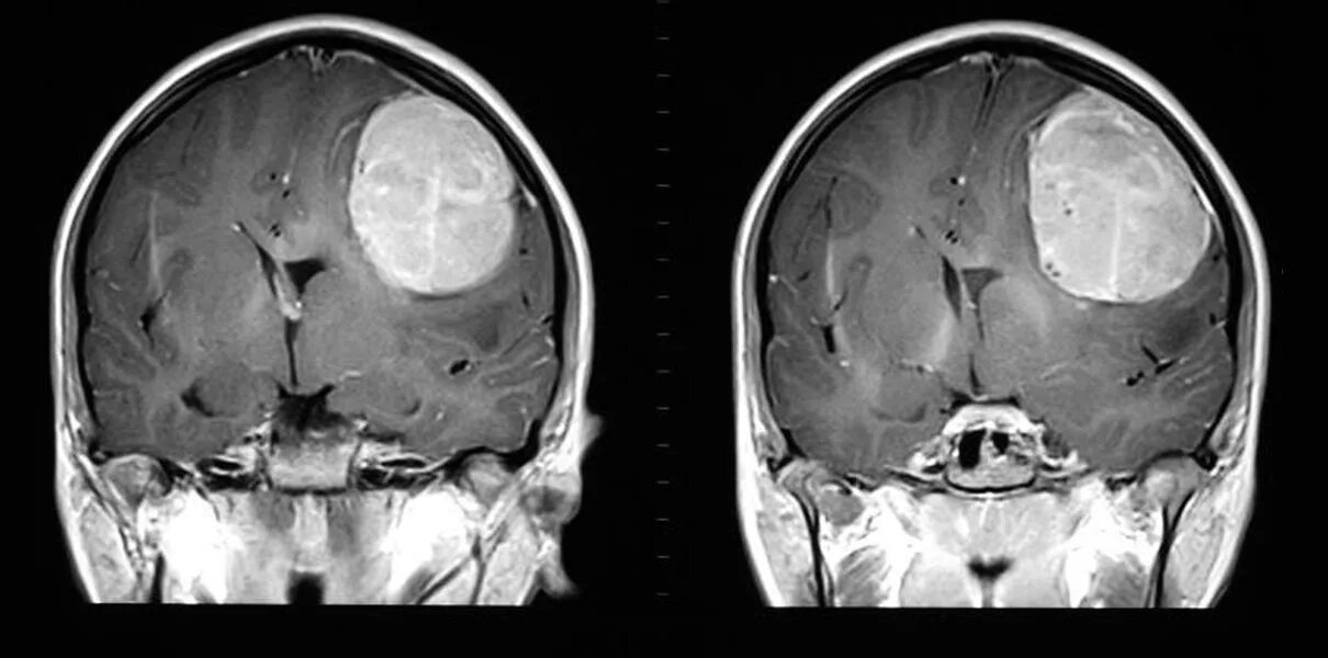Глиобластома головного мозга на кт и мрт. Глиобластома височно теменной области. Как выглядит опухоль головного мозга. Симптомы глиобластомы головного