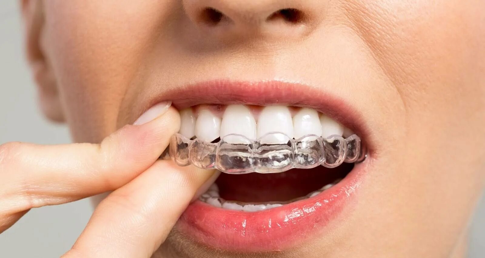 Каппы Инвизилайн. Элайнеры Invisalign. Ортодонт каппы элайнеры. Невидимые брекеты элайнеры.