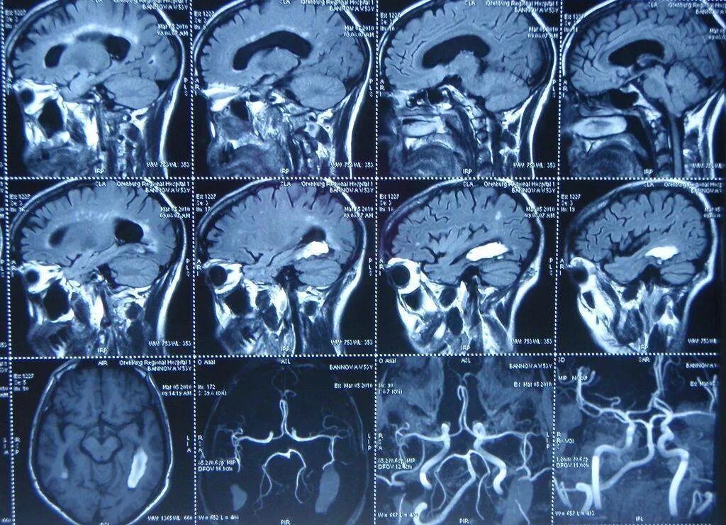 Кт томограмма головного мозга. Компьютерная томография кт головного мозга. Мрт (магнитно-резонансная томография) сосудов головного мозга. Кт (компьютерная томография) сосудов головного мозга.