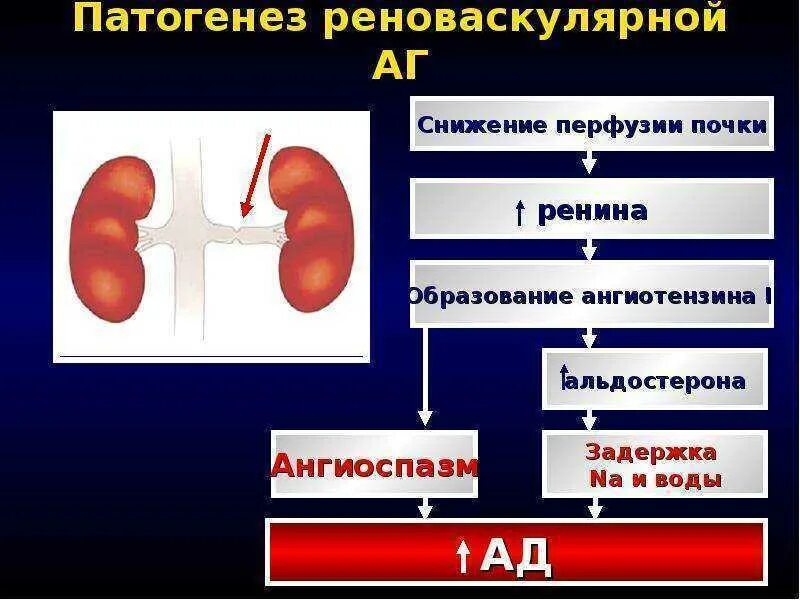 Почечная ренальная гипертензия. Ренальная артериальная гипертензия. Почечные гипертензии этиопатогенез. Реноваскулярной артериальной гипертензии. Патогенез почки