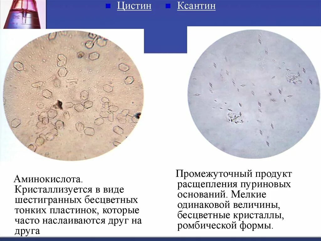 Повышен цистин в моче. Мочевая кислота микроскопия. Кристаллы цистина в моче микроскопия. Микроскопия неорганизованного осадка мочи. Микроскопия осадка мочи цистин.