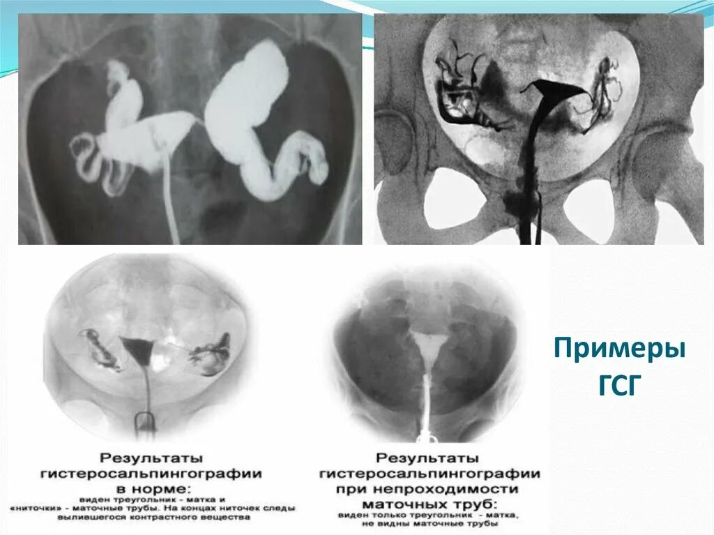 Забеременела при непроходимости труб. Гистеросальпингография проходимость маточных труб рентген. Непроходимость маточных труб снимок ГСГ. Снимок норма маточных труб. Метросальпингография непроходимость маточных труб.