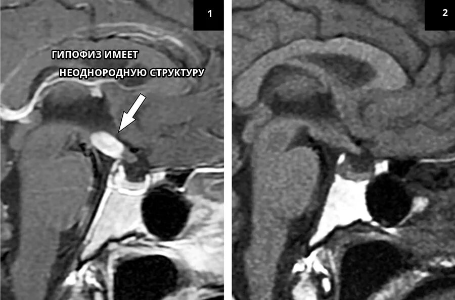 Диффузно неоднородная структура что это значит. Микроаденома гипофиза мрт. Кистозная аденома гипофиза. Аденома гипофиза мрт картина. Параселлярная аденома гипофиза.