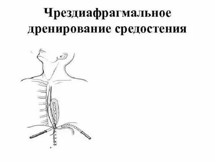 Хирургическое лечение медиастинитов
