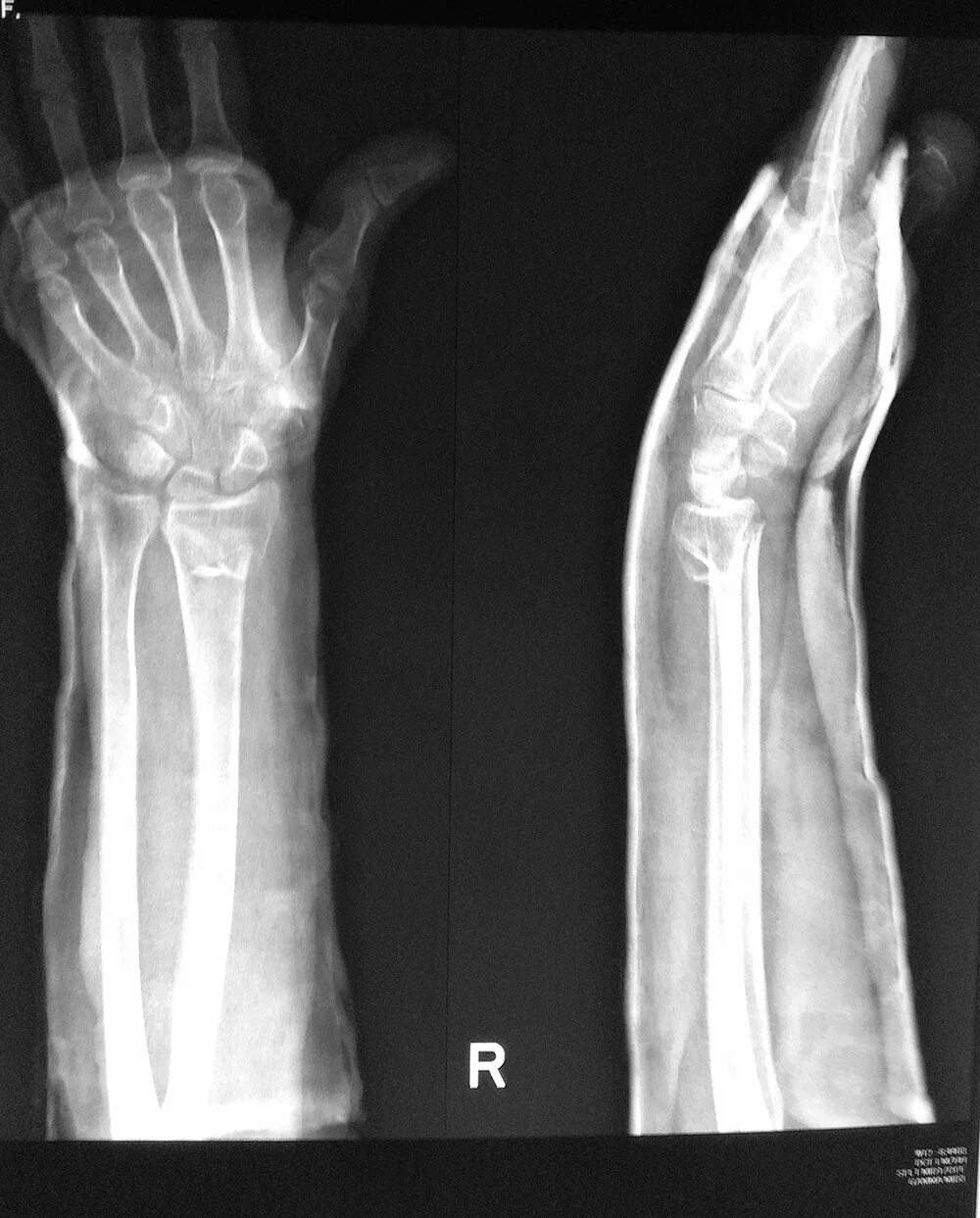 ✅ X-Ray Broken Arm Fixed with Metal Stock Photos