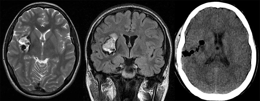 Кавернозная кавернома. Ангиома левой лобной доли головного мозга. Кавернозная ангиома головного мозга кт. Ангиома правой лобной