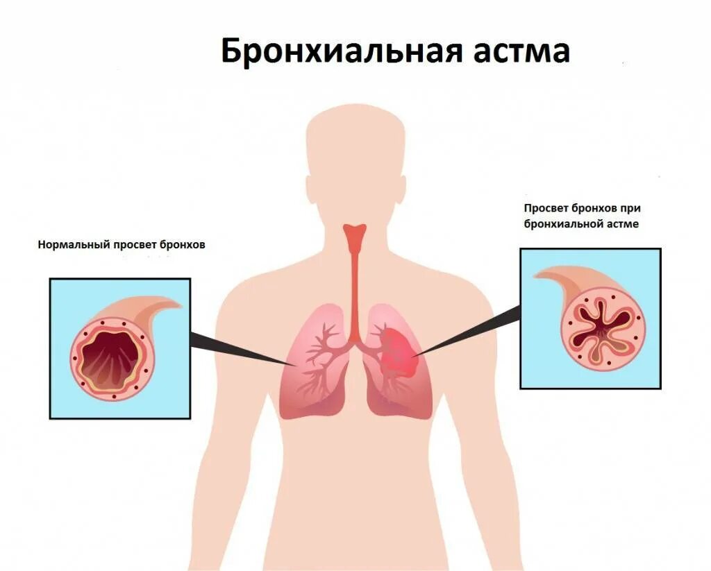 Бронхиальная астма. Бронхиальная астма легкие. При кашле.