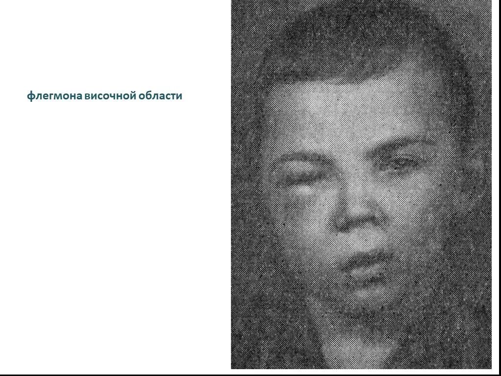 Абсцесс челюстного пространства. Абсцессы и флегмоны верхней челюсти.