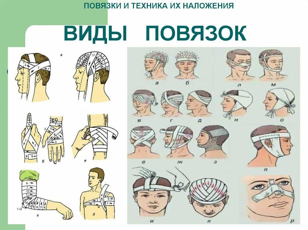 Основные типы повязок. Повязки (правила наложения, виды, схемы). Виды и типы повязок. Виды наложения повязок. Различные типы повязок.