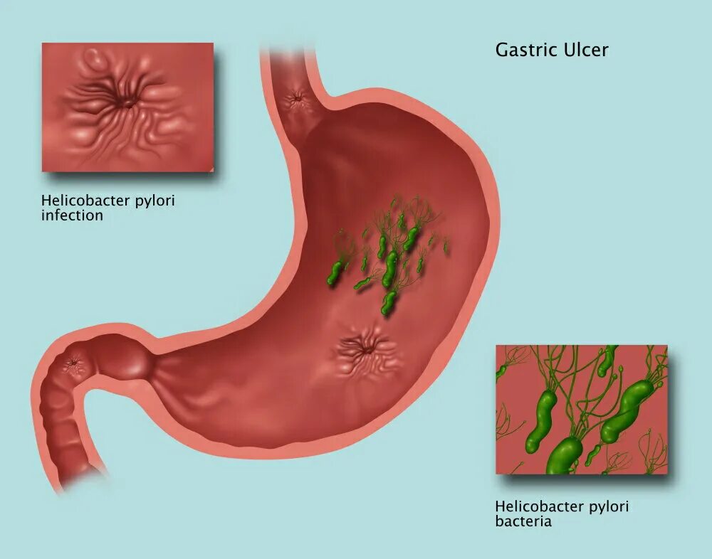 Язва желудка хеликобактер. Язва желудка Helicobacter pylori. Хеликобактер пилори язвенная болезнь. Хеликобактер пилори возбудитель. Язва желудка можно чай