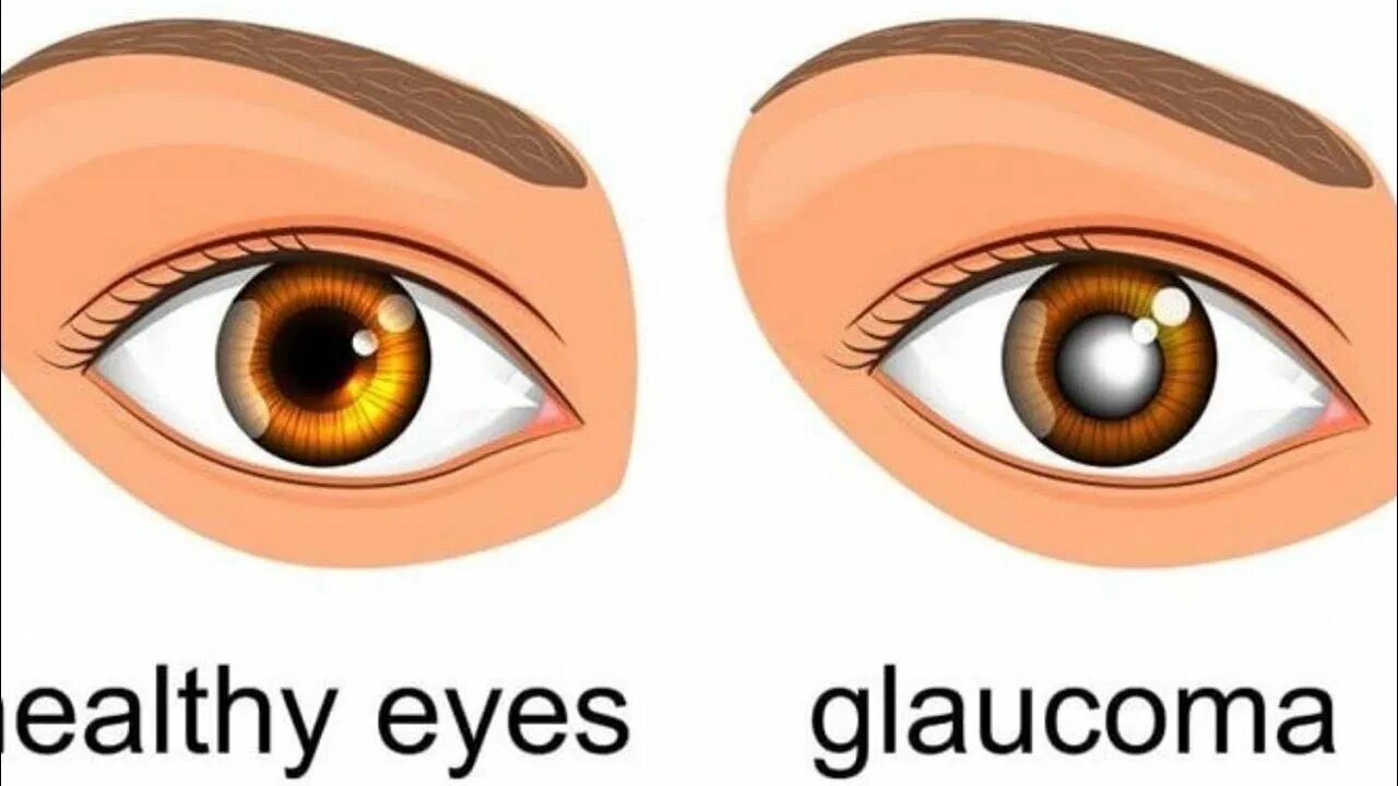 Здоровый глаз и глаз при глаукоме.