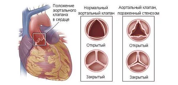 Стеноз аортального клапана. Операция стеноз аортального клапана. Аортальный клапан заболевания. Аортальные пороки сердца.