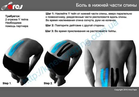 Тейпирование при грыже поясничного отдела
