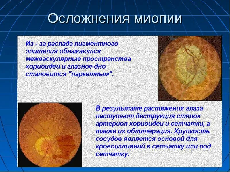 Миопия изменения на глазном дне. Миопический конус глазное дно. Глазное дно миопическая стафилома.