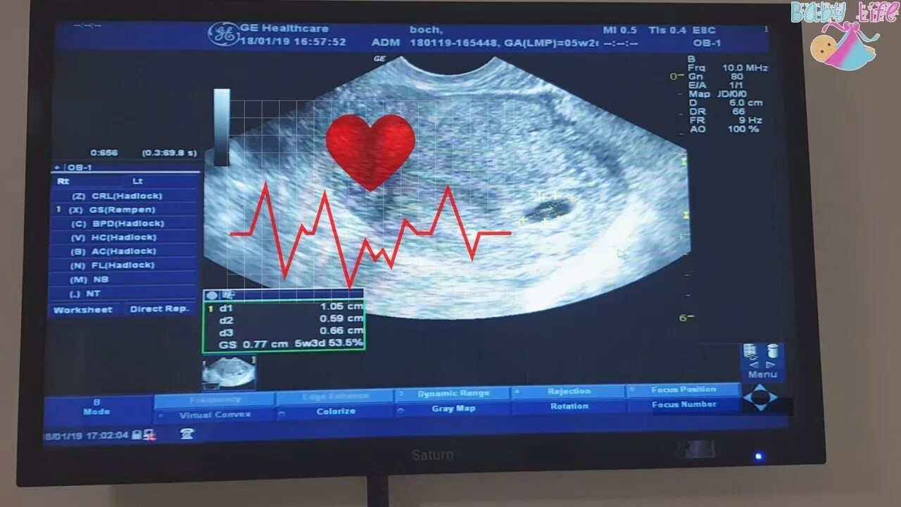 На какой неделе на узи слышно сердцебиение. Сердцебиение плода на УЗИ. Первое сердцебиение плода на УЗИ. Сердцебиение эмбриона на УЗИ. Сердцебиение на УЗИ аппарате.