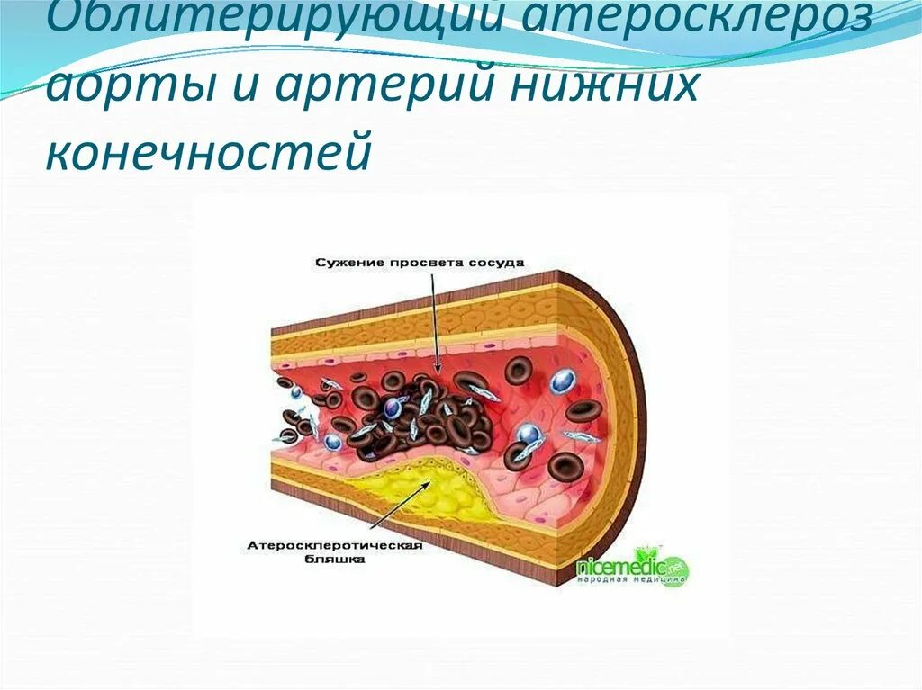 Облитерирующего атеросклероза сосудов конечности. Облитерирующий атеросклероз нижних конечностей этиология. облитерирующий атеросклероз сосудов конечностей. патогенез атеросклероза нижних конечностей. облитерирующий атеросклероз артерий нижних конечностей этиология.
