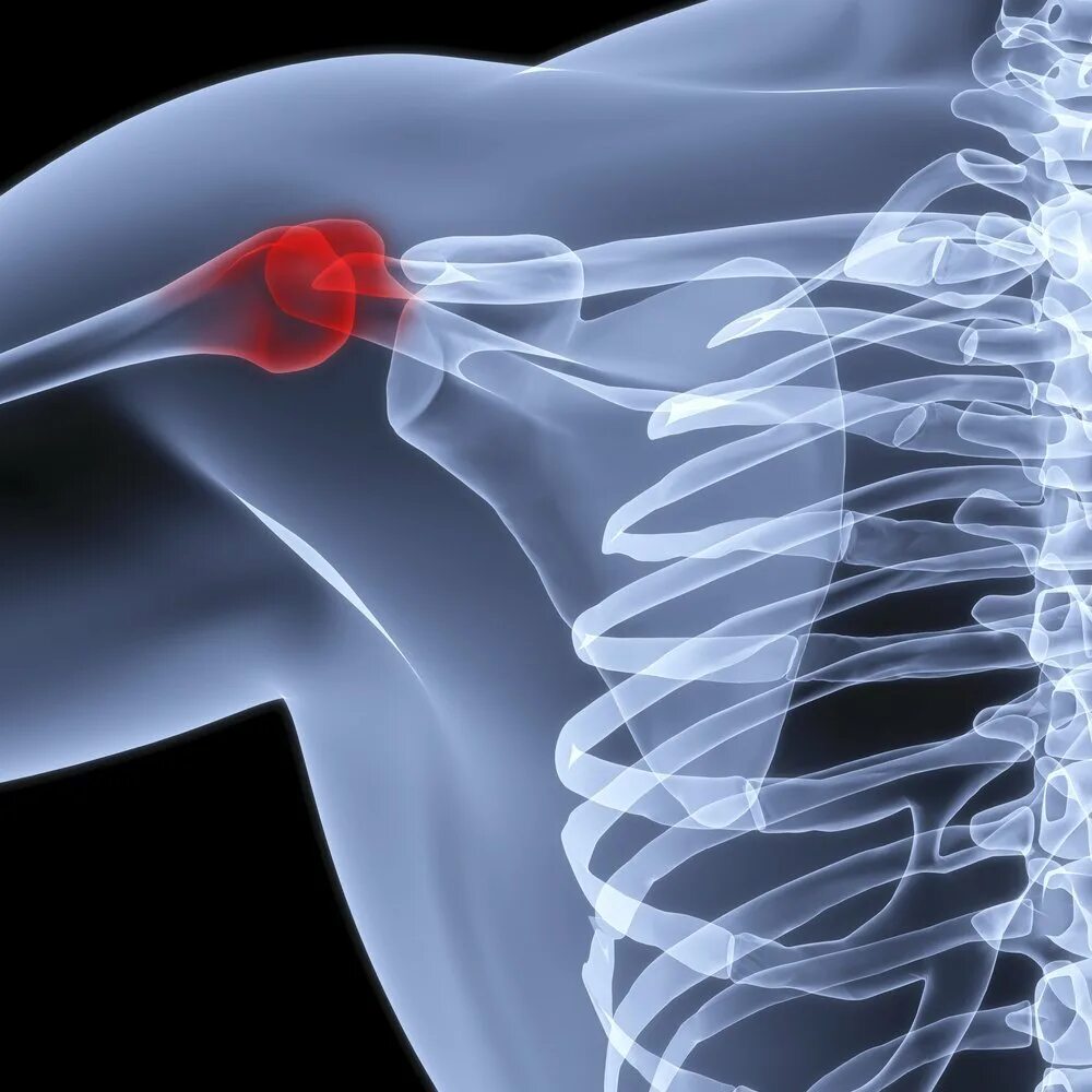 Плечелопаточныйпериартериит. Полиартрит плечевого сустава. Массаж плечевого сустава. Плечелопаточный полиартрит. Периартрит плечевого сустава синдром.